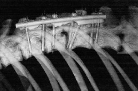 3-D пластины в практике нейрохирургии